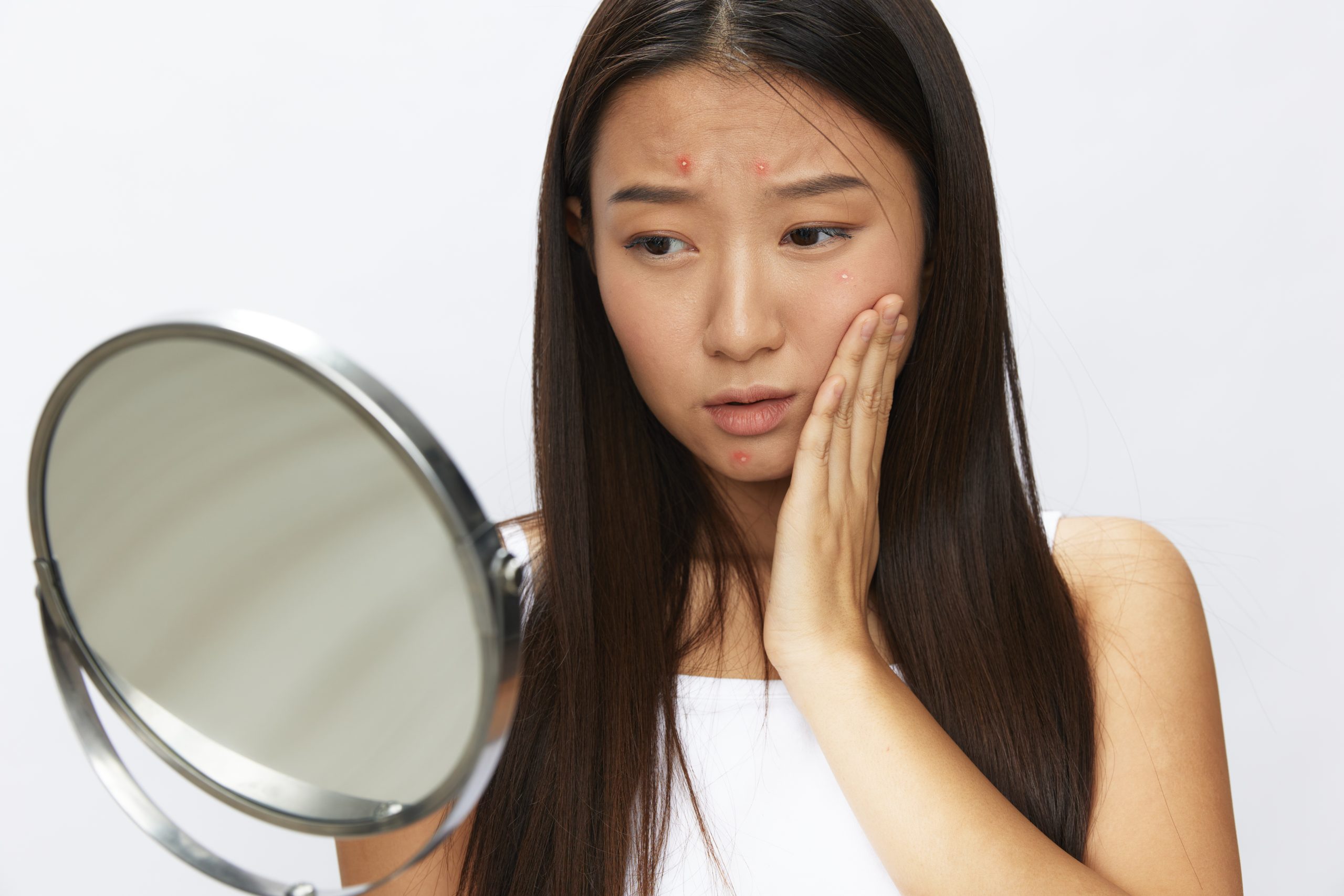 5 Ways to Prevent Pimples for Your Teenager