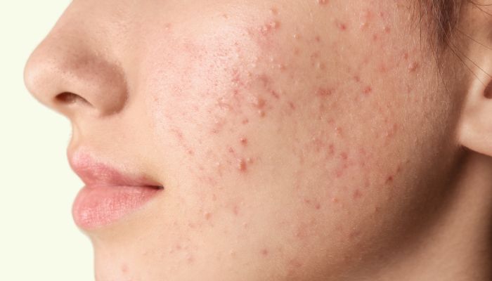 Impact of Acne on Skin Health: Why Timely Treatment Matters