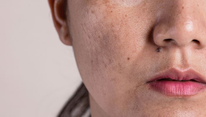 How To Reduce Dark Spots and Hyperpigmentation in Your Late 20s