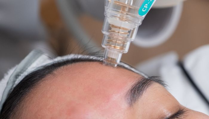 Achieve Youthful Skin with RF Microneedling and Exosomes