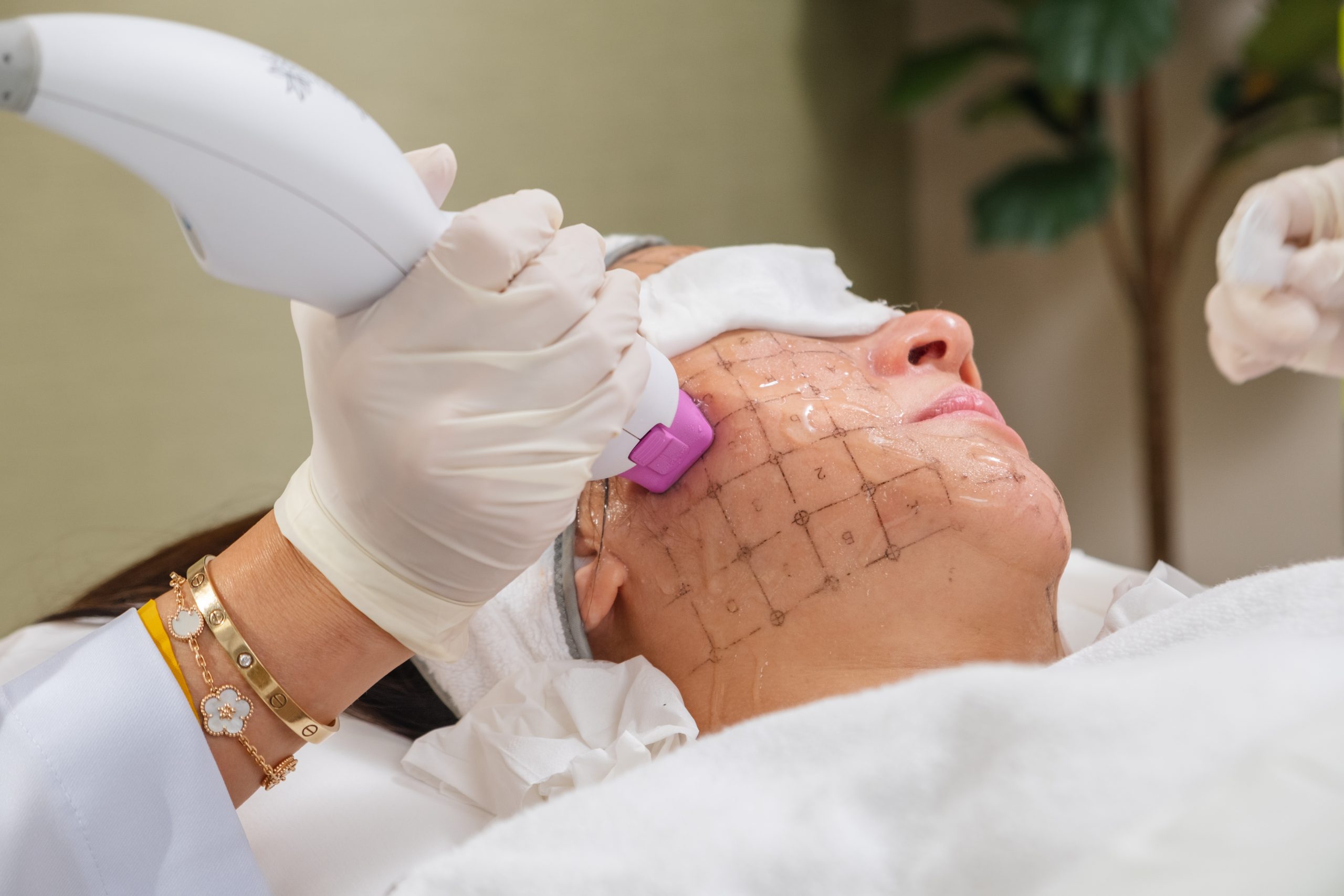How Thermage Treatments Work