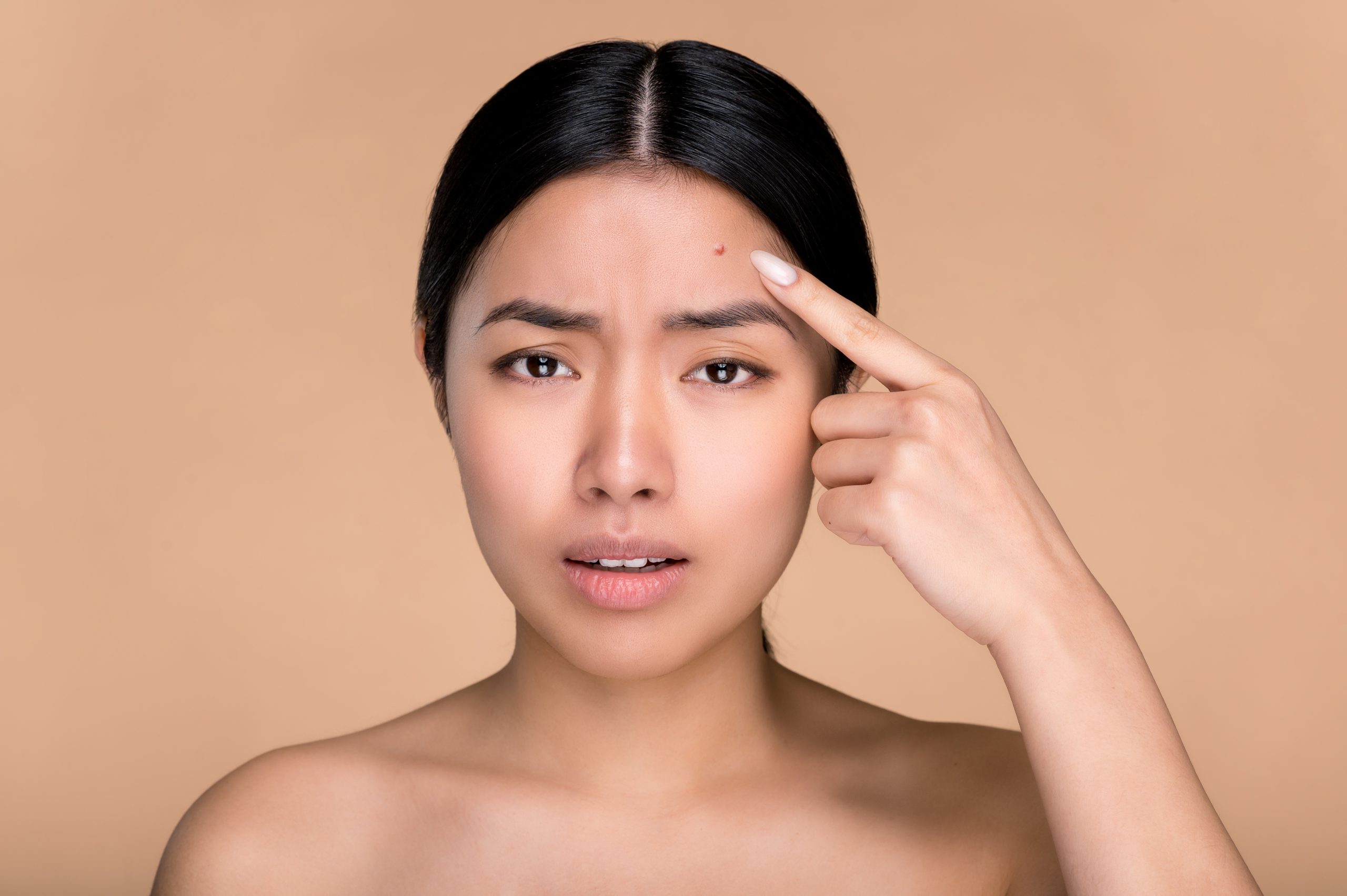 What Causes Acne: What’s Behind Pesky Pimples
