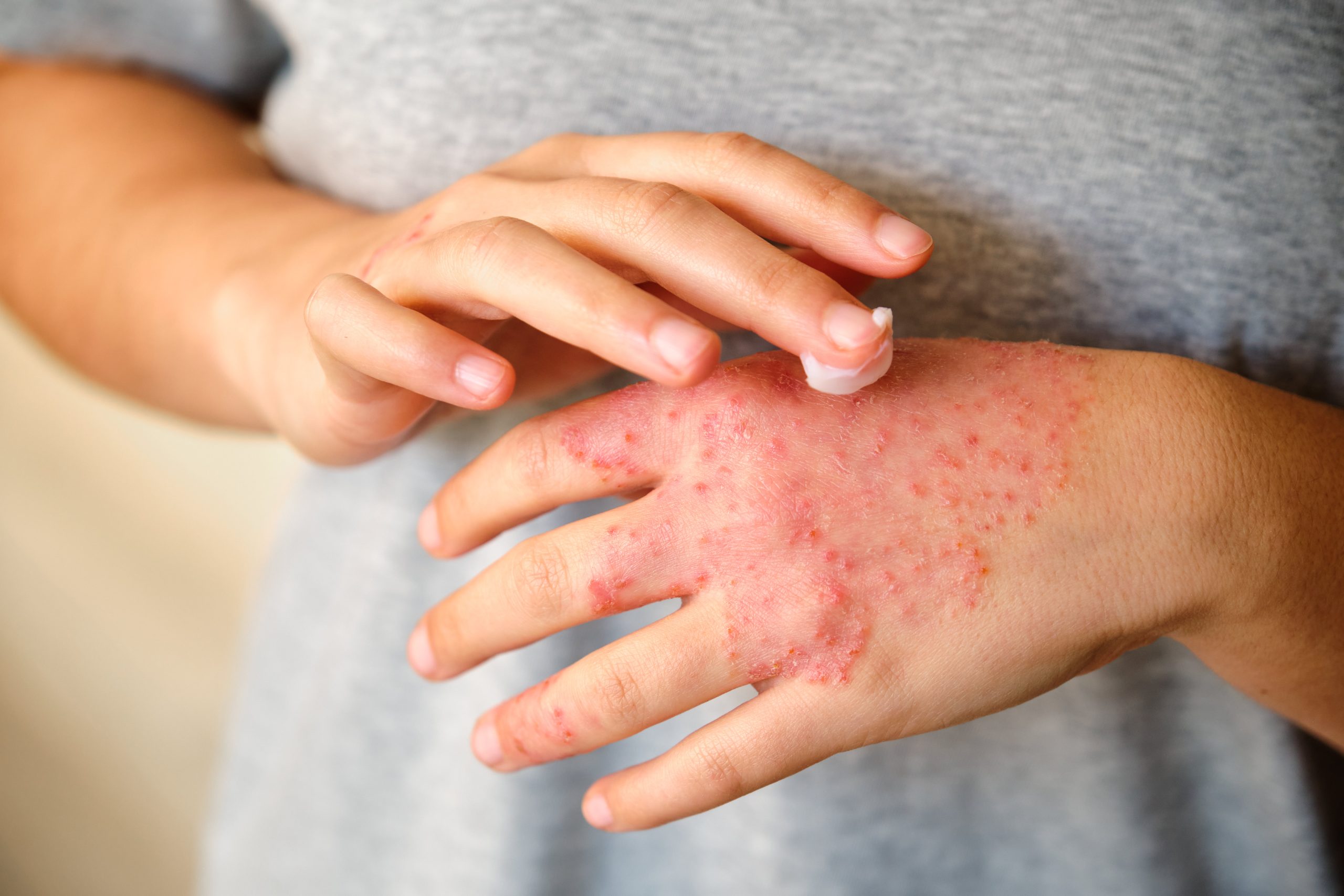 Identifying the Causes of Eczema Flare-Ups