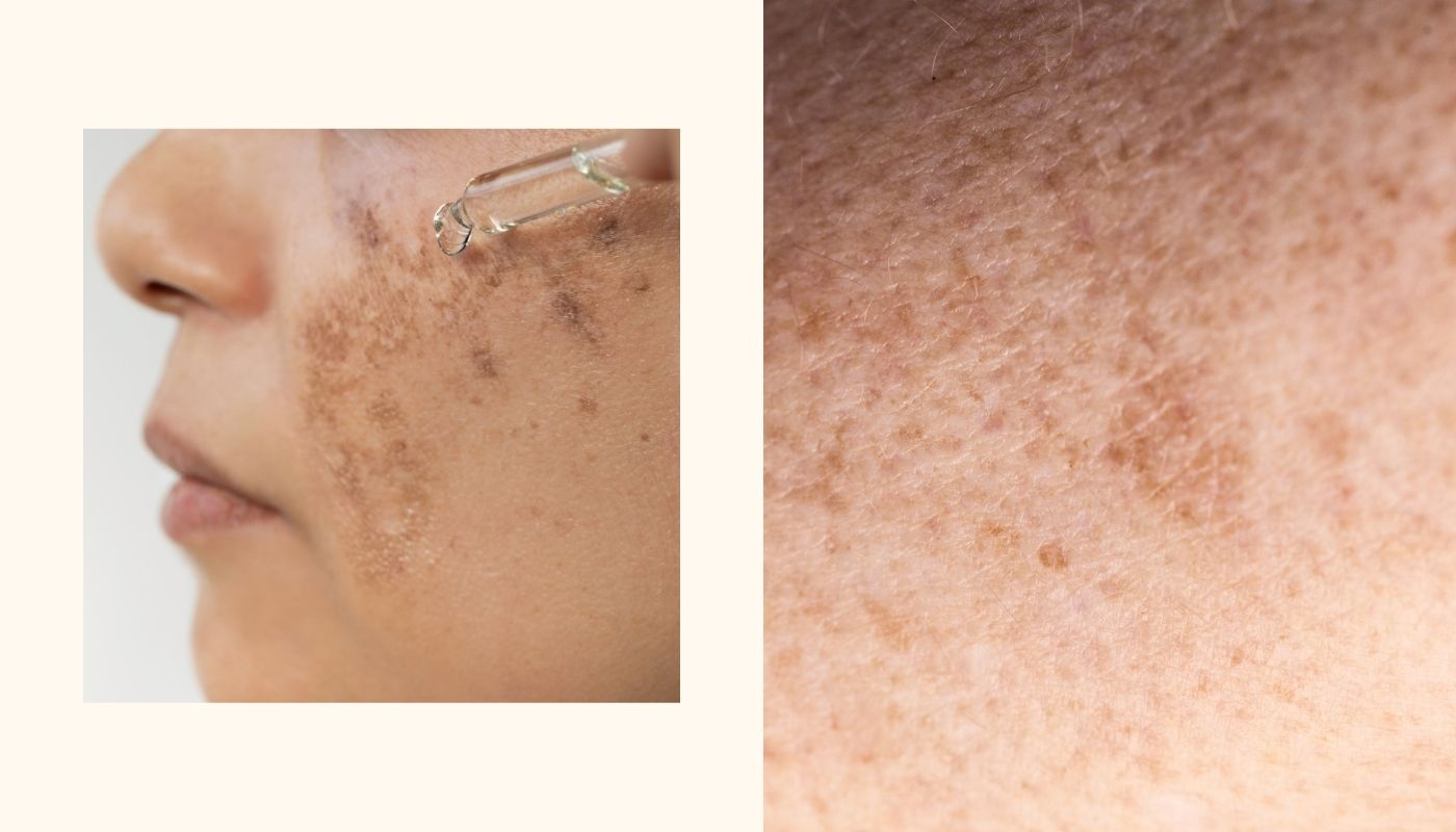 The Different Types of Hyperpigmentation and Their Causes