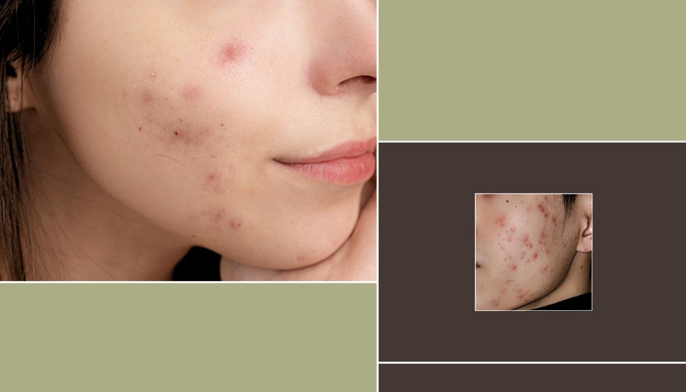 Acne 101: Understanding Different Types and Causes