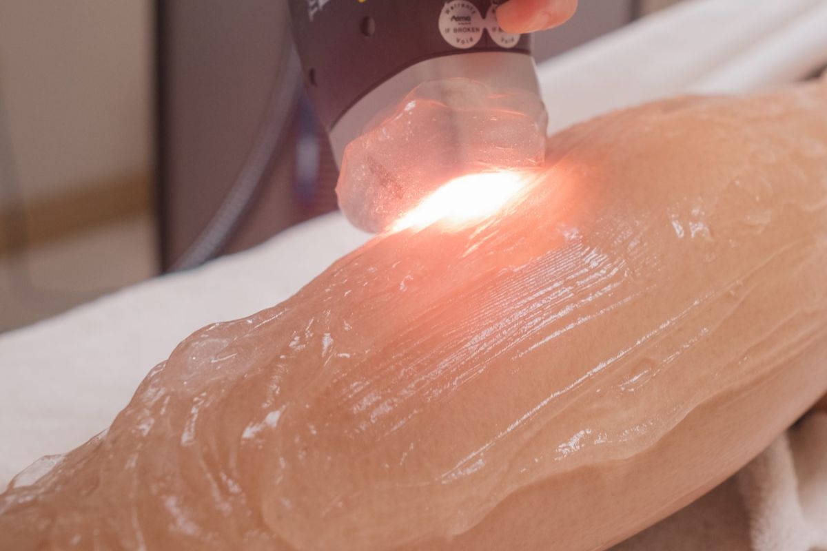 Step-by-step process of laser hair removal at Facial Care Centre