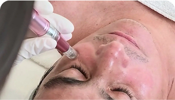 What to Know About ExoDerm, the Skin-Rejuvenating Treatment Every Guy Should Consider