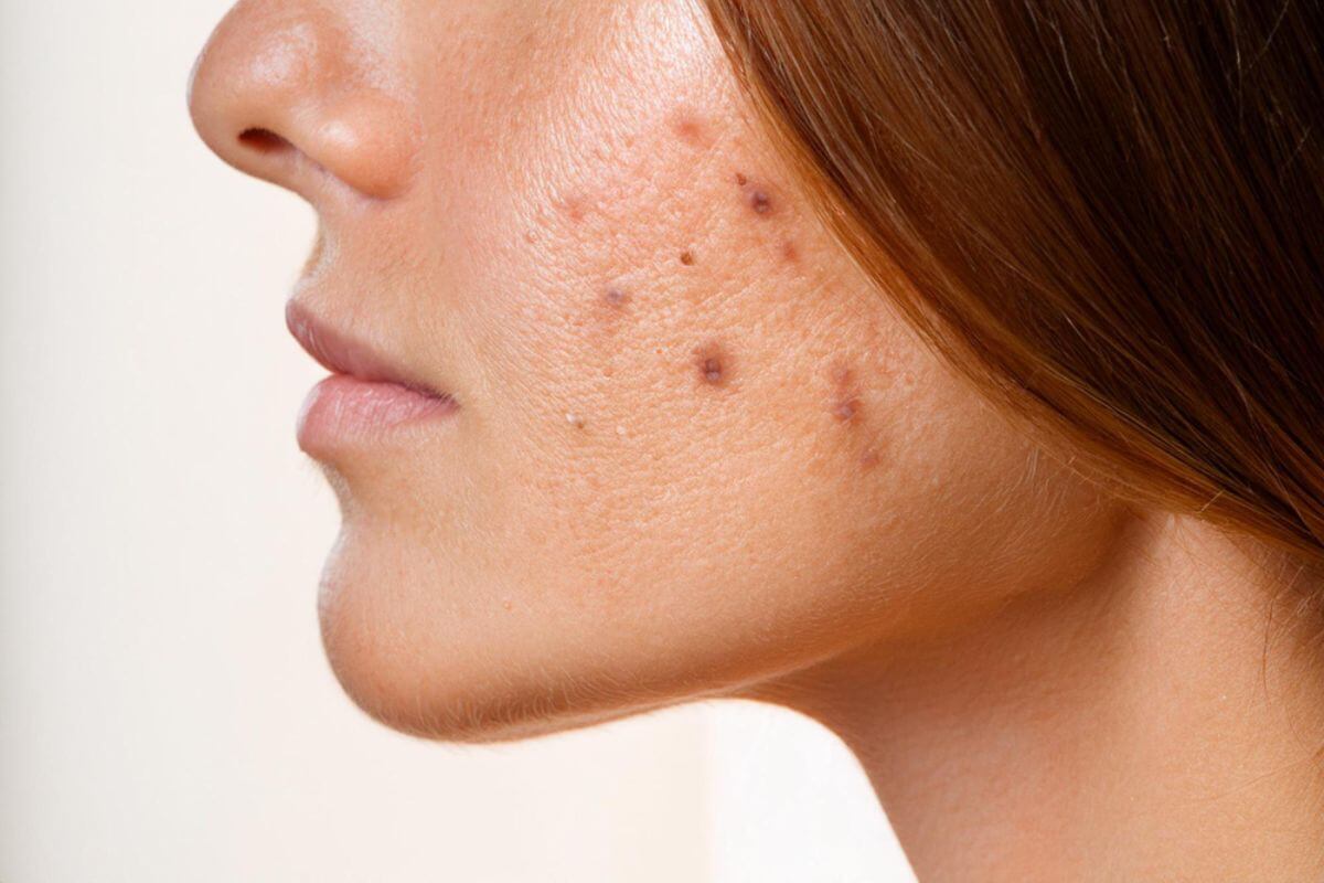 Dark spots and hyperpigmentation appearing on facial skin