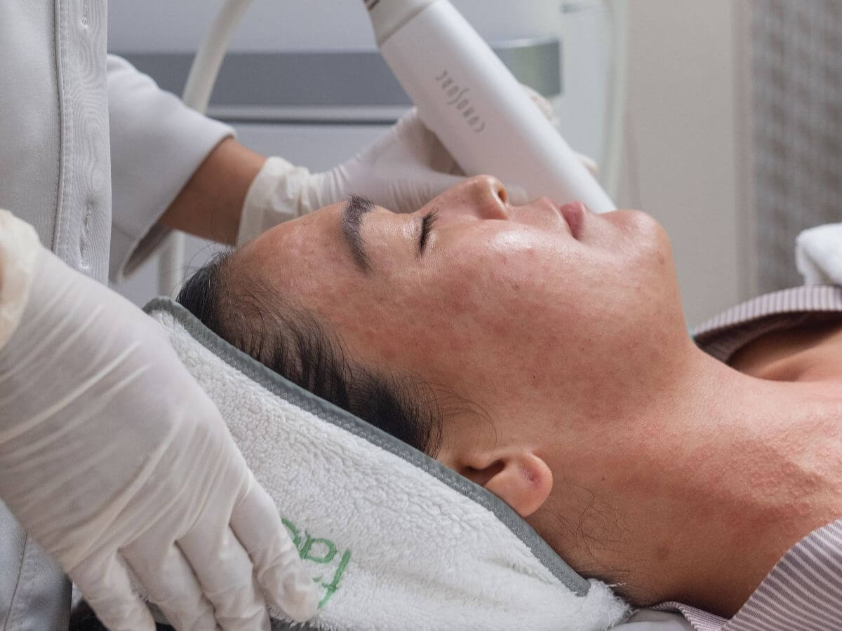 Woman undergoing Potenza treatment at Facial Care Centre for advanced skin rejuvenation, collagen stimulation, and improved skin texture and firmness.