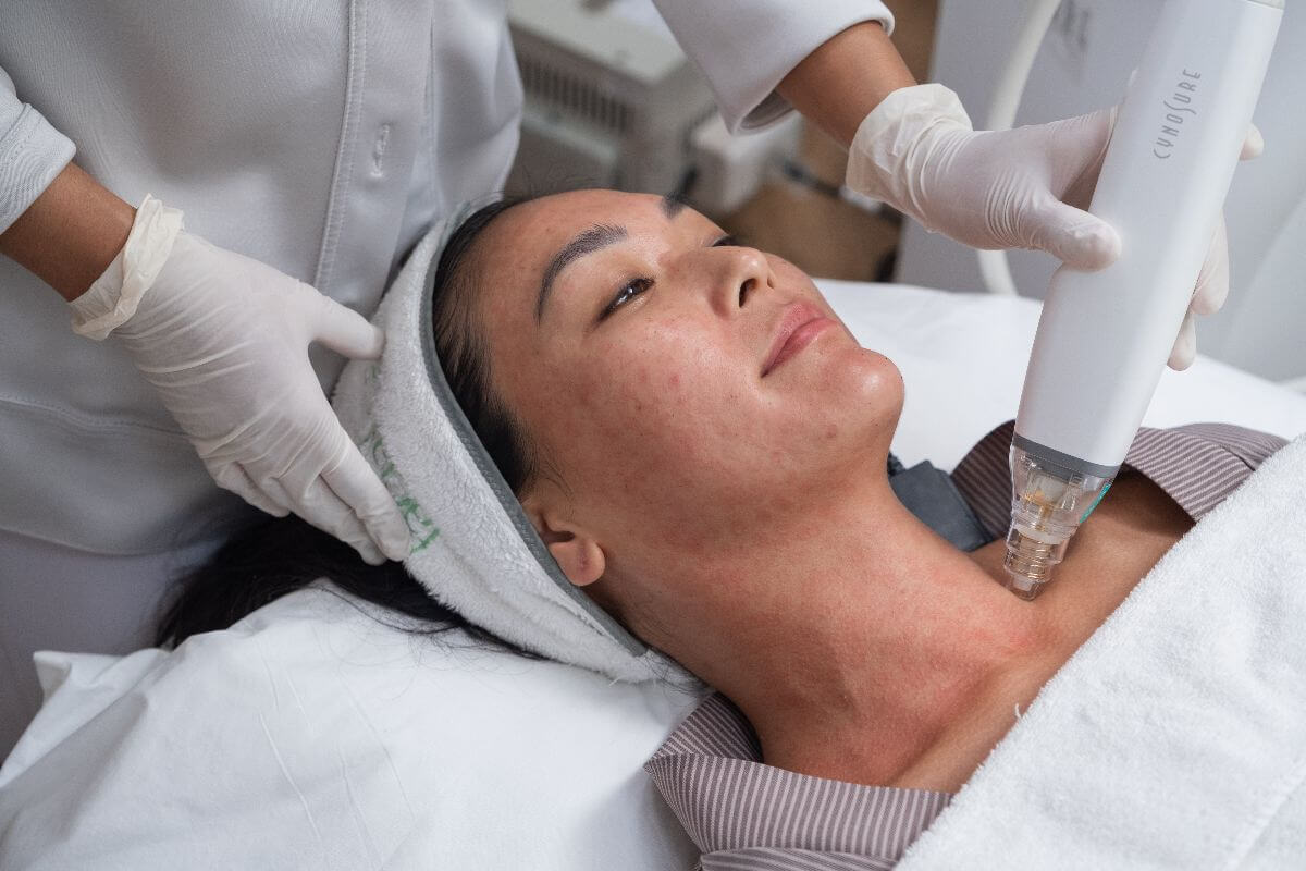 Woman undergoing Potenza treatment at Facial Care Centre, a laser rejuvenation procedure designed to improve skin firmness, texture, and overall skin quality.