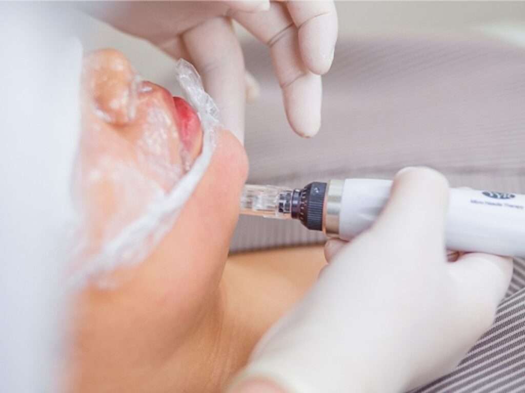 How to Choose the Right Facial Treatment for Pimple Marks in the Philippines