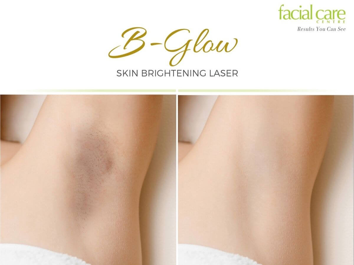 Before-and-after comparison showing the appearance of underarm skin following B-Glow skin brightening laser treatment